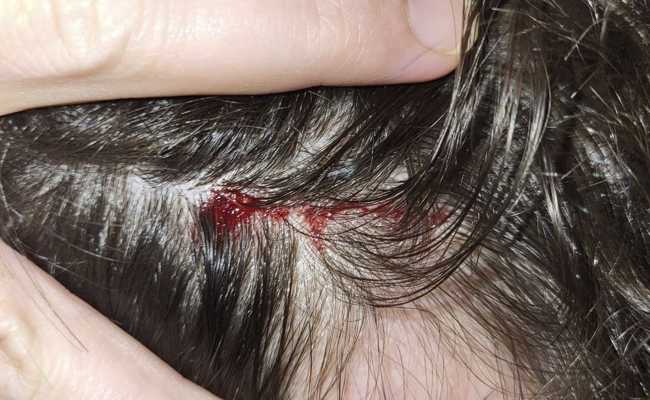 Greifvogel attackiert Jogger: «Fühlte sich an wie ein Schlag auf den Kopf»