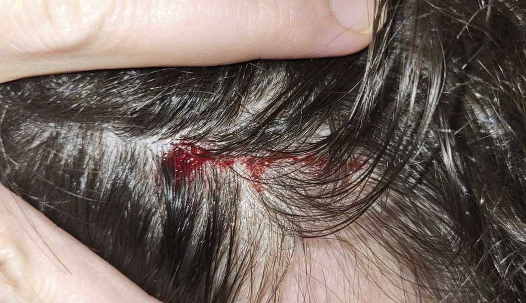 Ein Greifvogel fügte dem Jogger eine Wunde am Kopf zu. 